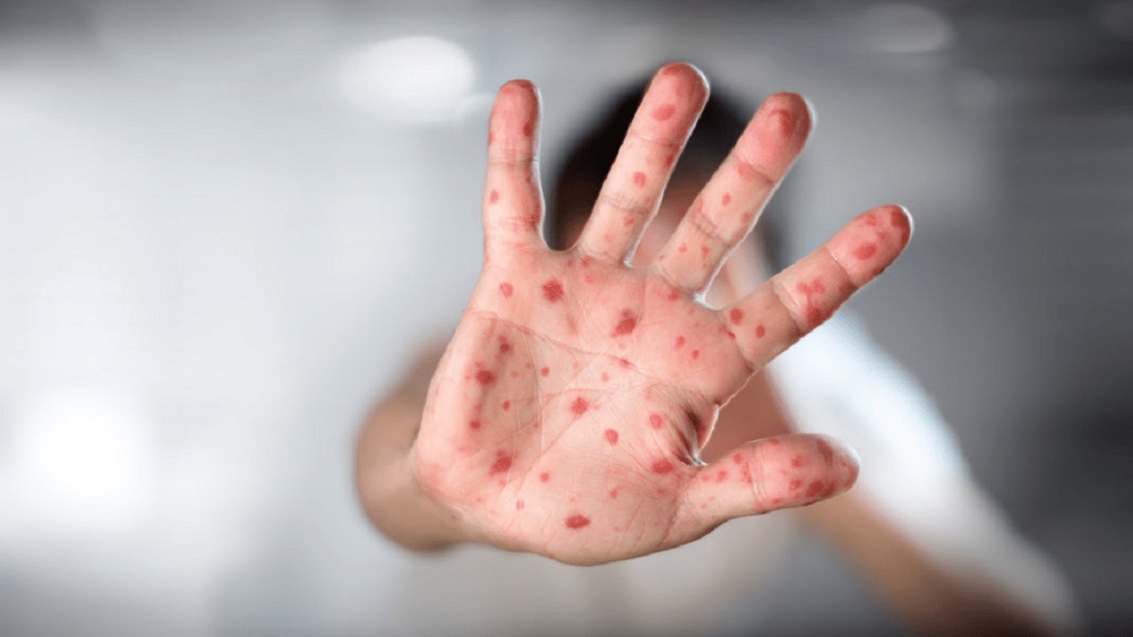 Alerta por los brotes de viruela del mono en Europa