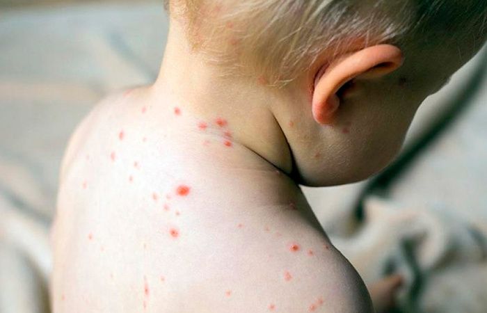 La Provincia confirmó el fin del brote de sarampión en territorio bonaerense